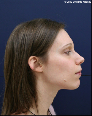 Marie-Hélène Cyr - Profil - Après des traitements d'orthodontie et des chirurgies orthognatiques (29 janvier 2010)